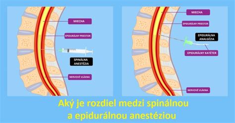 Schéma epidurálnej anestézie