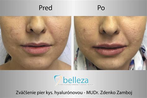 Fullips pomôcka na zväčšenie pier