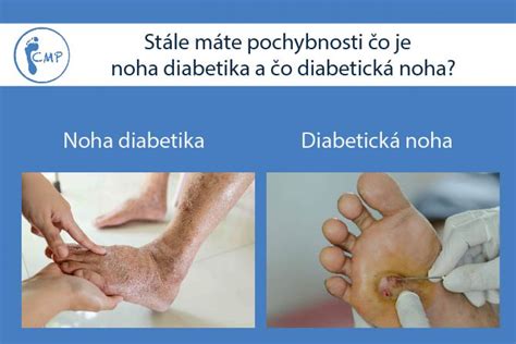 Ilustrácia syndrómu diabetickej nohy