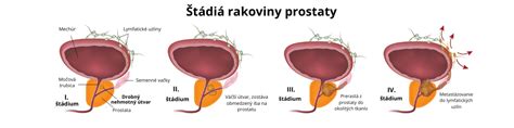 Štatistiky výskytu rakoviny prostaty vo svete