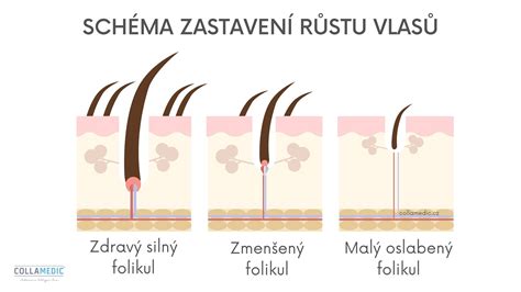 Schéma fungovania laserovej epilácie: laserový lúč a vlasový folikul