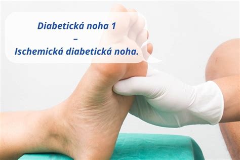 Diabetická noha: Prečo je prevencia taká dôležitá?
