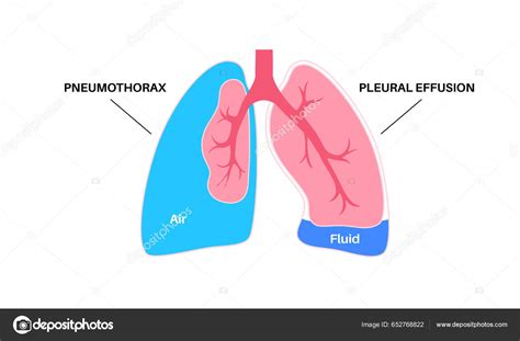 Pneumotorax vs. Pleurálny výpotok - porovnanie stavov
