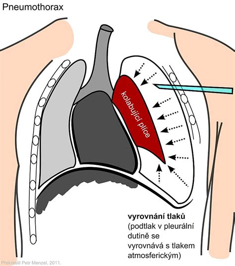 Porovnanie liečby pneumotoraxu a pleurálneho výpotku