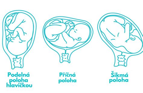 Schéma polohy plodu v maternici