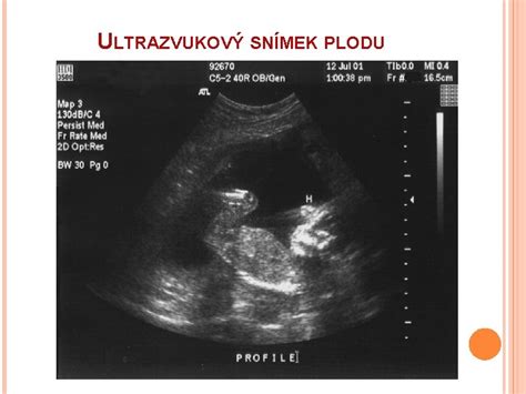 Ultrazvukový snímok plodu v polohe KP