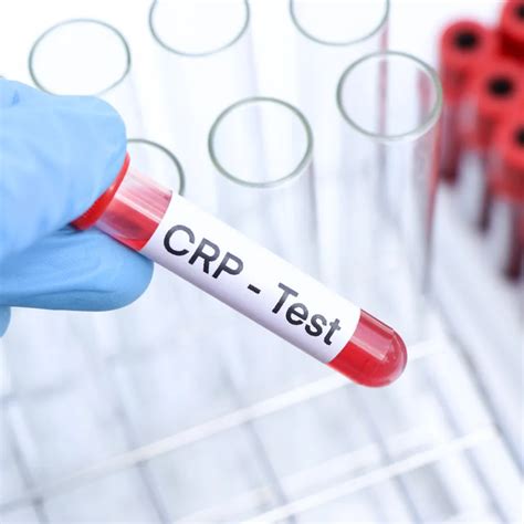 CRP test pre diagnostiku infekcií