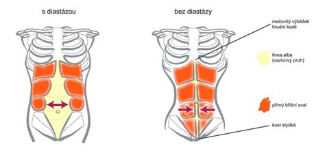 Schéma anatómie brušnej steny a znázornenie diastázy