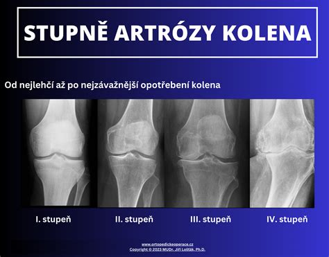 Röntgenový snímok kolena s vyznačeným poškodením ACL