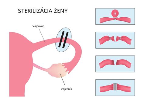 Sterilizácia menštruačného kalíška vriacou vodou
