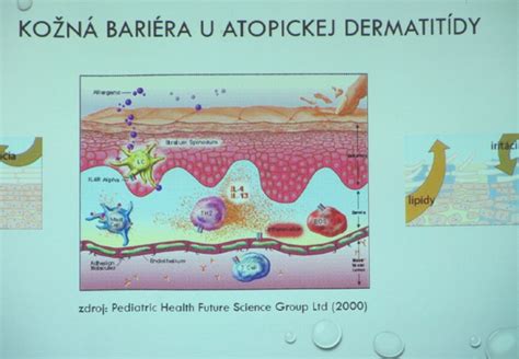 Prevalencia atopickej dermatitídy