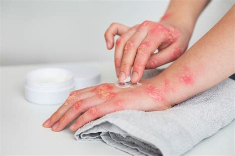 Cykly atopického ekzému: vzplanutie a remisia