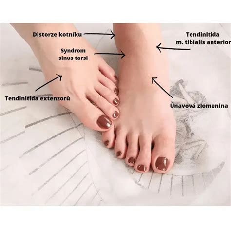 Obrázok chodidla s pľuzgierom od topánky