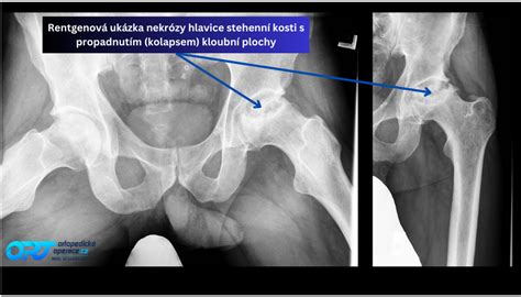 Schéma bedrového kĺbu s označením hlavice stehennej kosti a acetabula