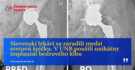 Schéma totálnej endoprotézy bedrového kĺbu