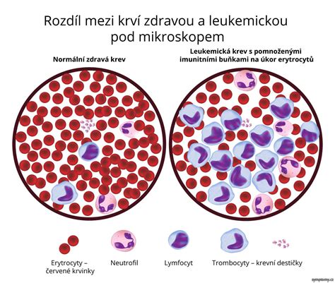 Rozdiel medzi zdravou a leukemickou krvou