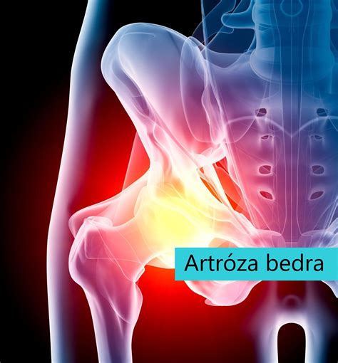 Štádiá artrózy bedrového kĺbu