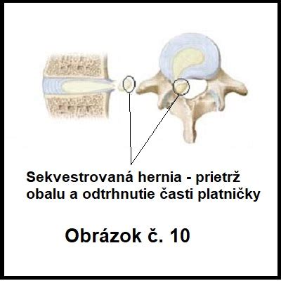 Ilustrácia opotrebovaných medzistavcových platničiek a výrastkov na stavcoch