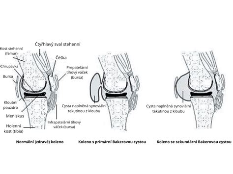 Bakerova cysta anatomický pohľad
