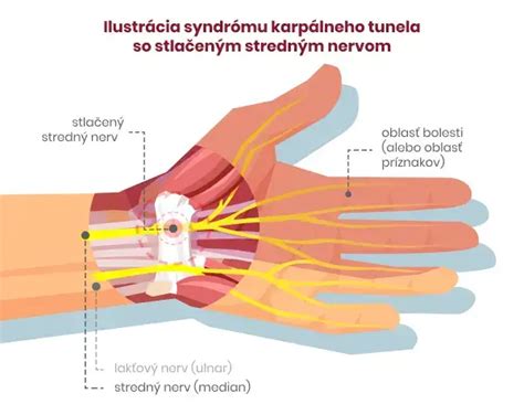 Útlak nervov v oblasti zápästia a lakťa