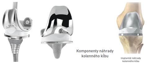 Zobrazenie endoprotézy kolenného kĺbu