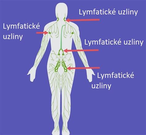 Opuchnuté lymfatické uzliny pri angíne