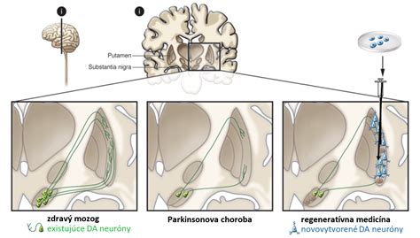 Schéma mozgu a dopamínových ciest pri Parkinsonovej chorobe