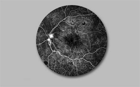 Diabetická retinopatia - poškodenie sietnice