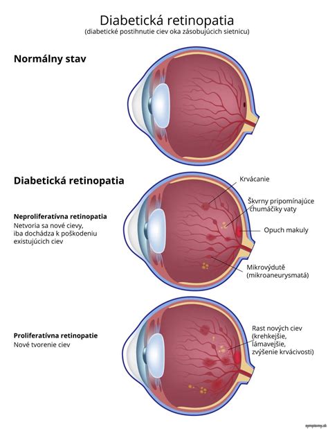 Rizikové faktory diabetickej retinopatie