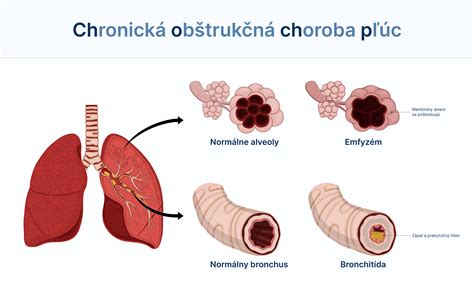 Schéma pľúc postihnutých CHOCHP