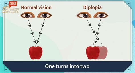 Škúlenie a diplopia: vizuálne príklady