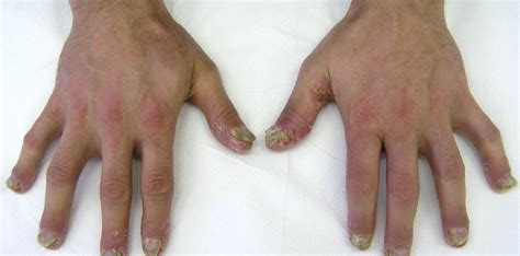 Psoriatická artritída - Prepojenie psoriázy a zápalu kĺbov