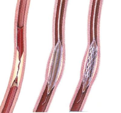 Postup angioplastiky a zavedenia stentu