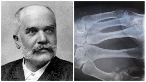 Prvý röntgenový prístroj