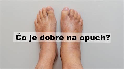 infografika s dôsledkami plochých nôh na telo