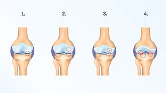Schematické znázornenie artrózy medzistavcových kĺbov