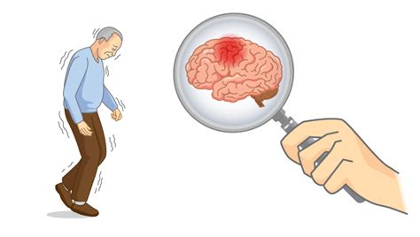 symbolické znázornenie Parkinsonovej choroby